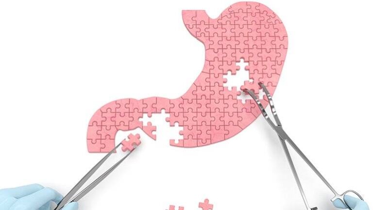 obezite ameliyati gecirenlerde revizyon cerrahisi girisimi yayginlasiyor OGVus9D3